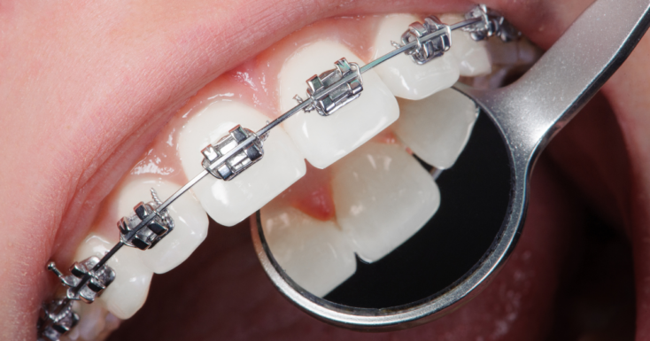 beneficios ortodoncia