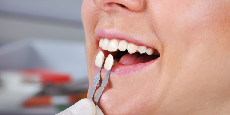 Alargamiento coronario: qué es y cómo mejora la estética de tu sonrisa