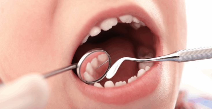 sellado dental ninos