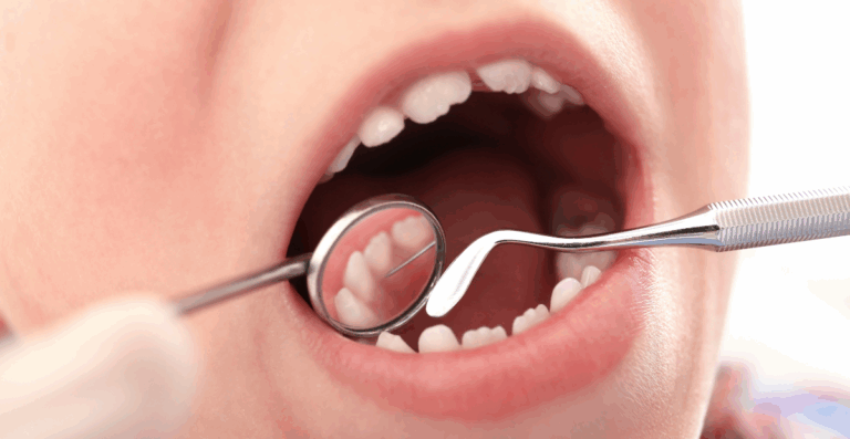 La importancia del sellado dental en niños