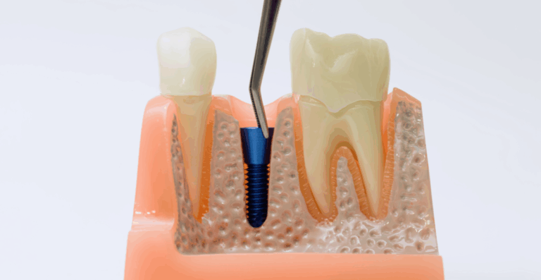 Implantes de carga inmediata: ventajas y riesgos reales