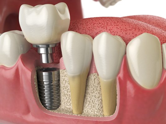 codinadental-implantes-dentales